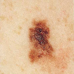 Melanoma