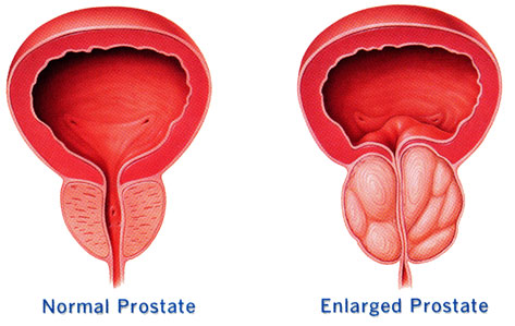 Prostate