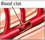 Blood clot